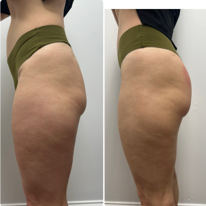 Soft-Cellulite-Protocol-followed-by-Mesosphere-glute-lifting